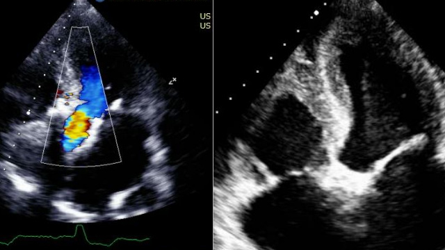 TAVI: management of unusual complications