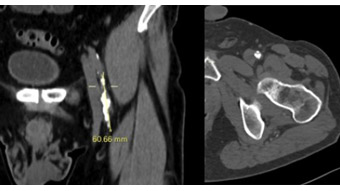 Technical solutions for a successful femoro-popliteal complex desobstruction