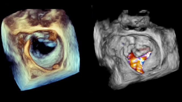 The Edwards PASCAL transcatheter valve repair system