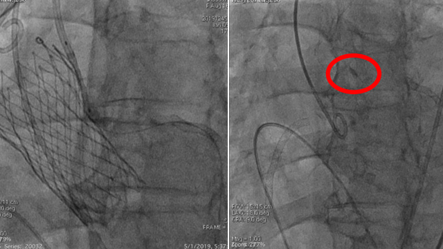 The most common TAVI complications