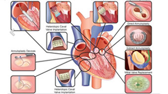 The year in intervention: essential publications from the EuroIntervention Journal and the European Heart Journal