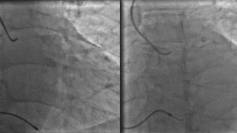 Unexpected consequences from this surgery and intervention