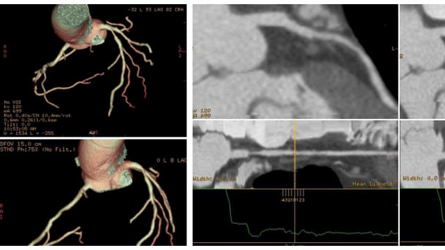 This case would have been different without intracoronary imaging