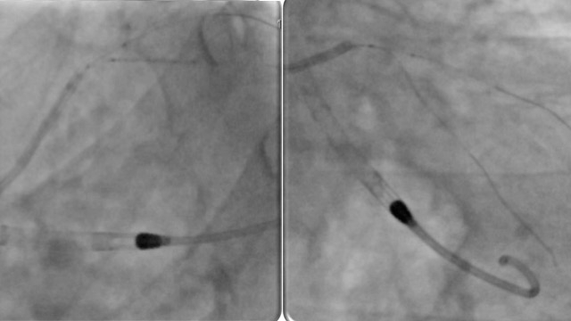 Tools and devices for complex left main PCI
