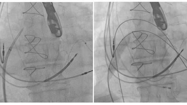 Transcatheter mitral valve-in-valve intervention and paravalvular leak closure