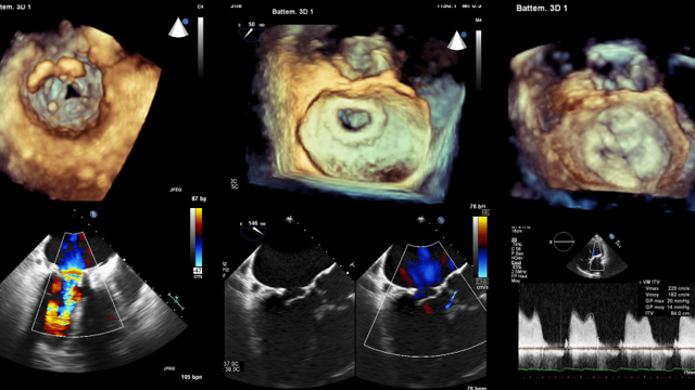 Transcatheter mitral valve interventions in failed mitral repair, replacement and mitral stenosis