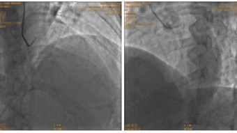 Transforming DCB strategy: sirolimus-coated balloon with Nanolute technology