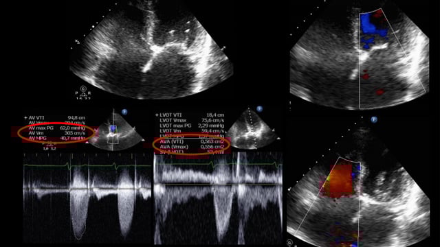 Transforming patient access and care for valvular heart disease