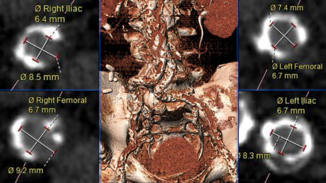 Treatment of aortic stenosis for today - Important considerations for the future