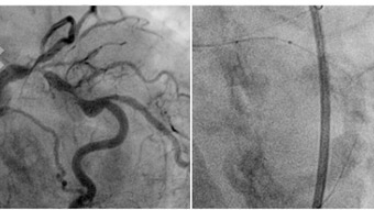 Treatment of calcified coronary lesions: rotablation and beyond