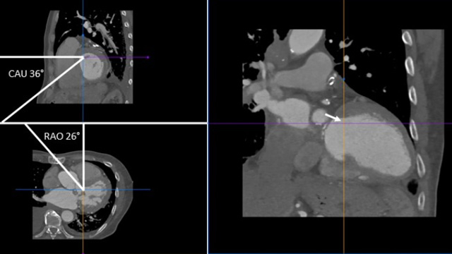 Treatment options for valvular and paravalvular mitral regurgitation - Hosted by Italy and Switzerland