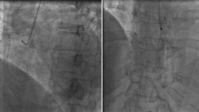 Treatment strategies for challenging STEMI cases