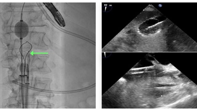 Unusual interventional solutions for complex problems - Part 2