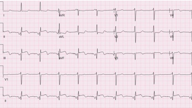 Unusual STEMI cases