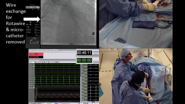 Update on management of complex calcified coronary lesions