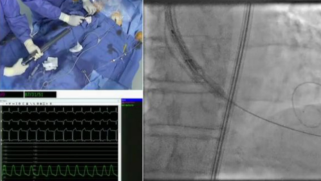 Updates in TAVI therapies