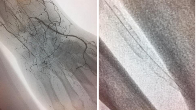 Upper limbs CTO management