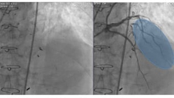 Useful unusual approaches in complex CTO interventions