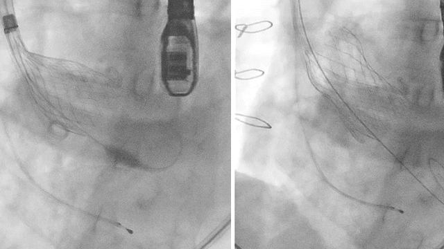 Valve-in-Valve: current evidence and contemporary practice