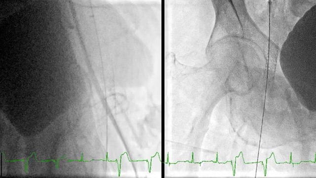 Vascular complications after TAVI