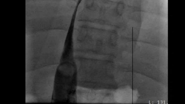 Venous interventions