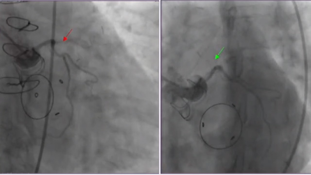 When aortic stenosis is not the only issue...