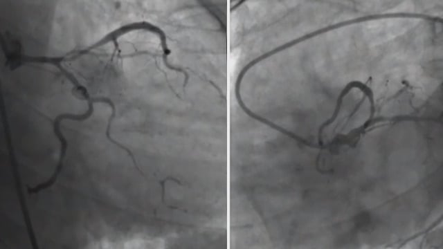 When the clock is ticking: managing complex STEMI patients and making timely touch calls