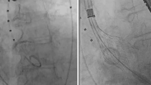 Will the Evolut Low Risk trial change my practice?