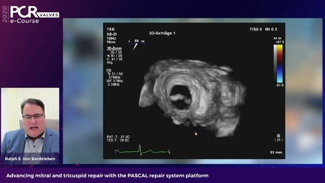 Advancing mitral and tricuspid repair with the PASCAL repair system platform