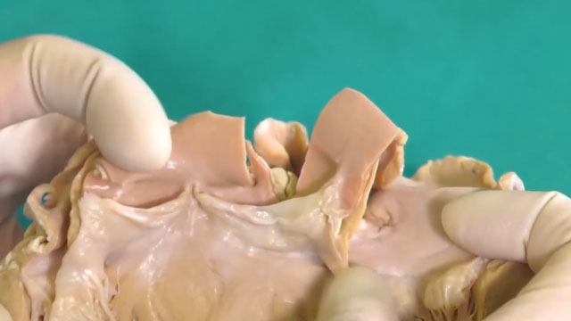 Aortic anatomy and pathology basis for the structural interventional team