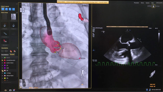 Beyond the evolution!  Latest image guided therapy for structural heart disease intervention 2.0 era