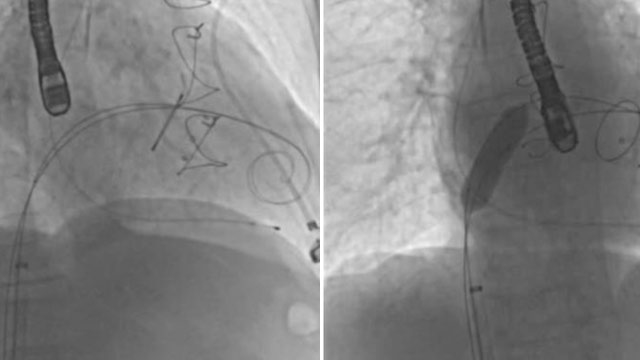 Cases in mitral