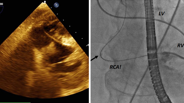 Cases in TAVI