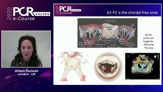 Challenging situations during mitral edge-to-edge repair: a case-based approach