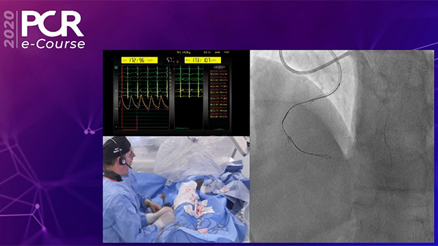 CTO procedures: the antegrade approach