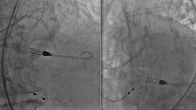 How to optimise coronary intervention therapy with SAPIEN 3