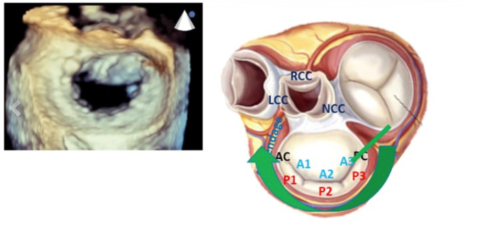 Imaging Day - Case-based imaging for the mitral valve