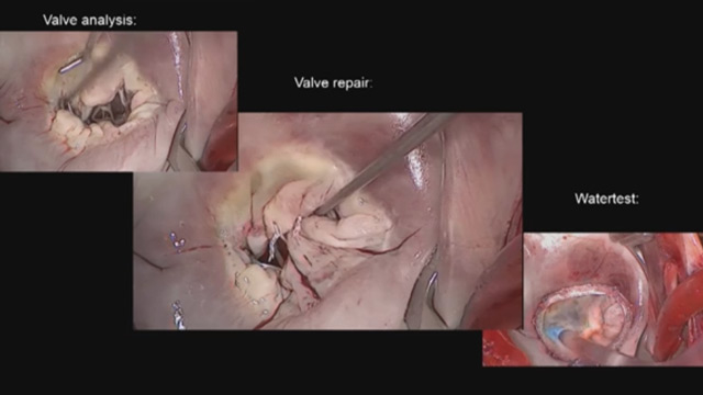 Innovations in surgical and transcatheter mitral valve intervention