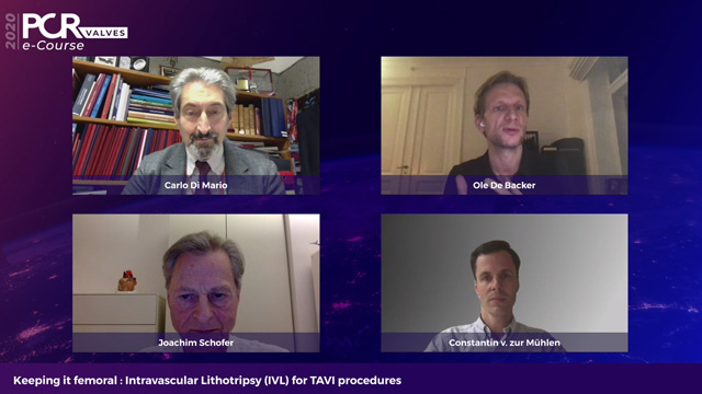 Keeping it femoral: Intravascular Lithotripsy (IVL) for TAVI procedures