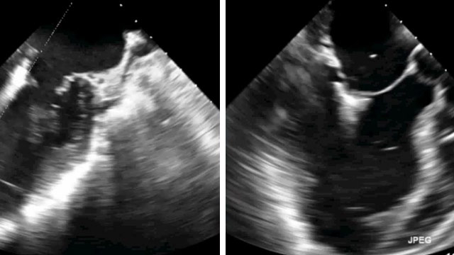 Learnings from a decade-long experience of TMVR procedures with MitraClipTM