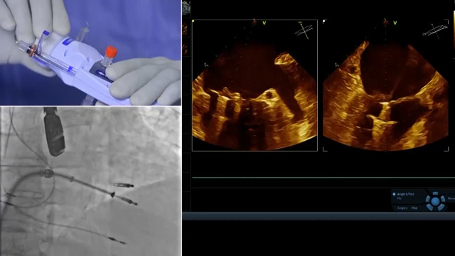 MitraClip for primary mitral regurgitation case