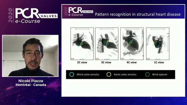 Multi-modality imaging for transcatheter aortic valve interventions