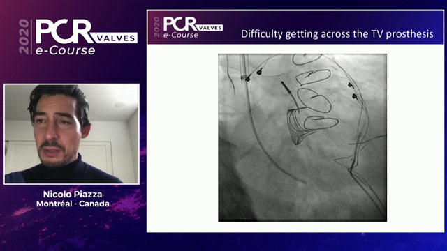 Multi-modality imaging for transcatheter tricuspid valve interventions