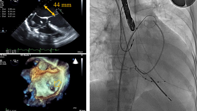 Strategies to handle complications during interventions for structural heart disease