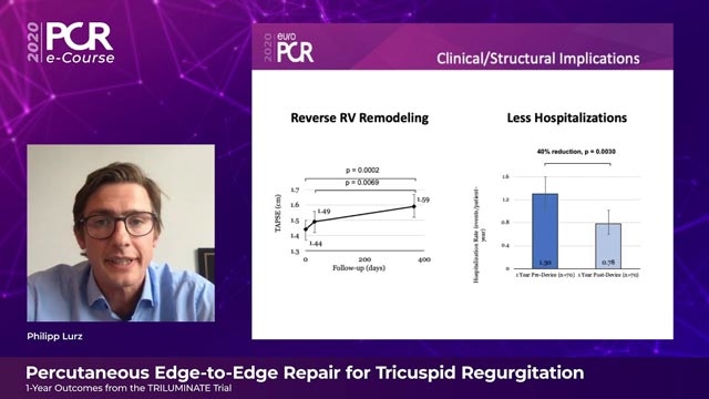Percutaneous edge-to-edge repair for tricuspid regurgitation: 1-year outcomes from TRILUMINATE trial