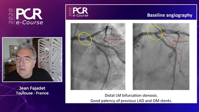 Optimal left main bifurcation stenting technique: a patient-centred approach
