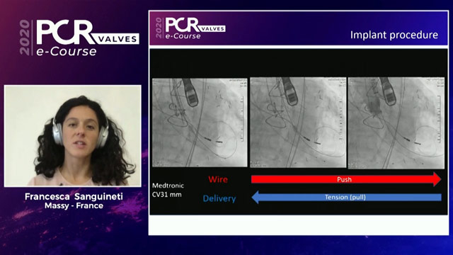 TAVI complications: Part 1