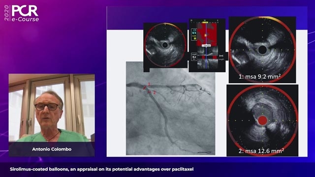 Sirolimus-coated balloons, an appraisal on its potential advantages over paclitaxel