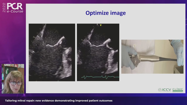 Tailoring mitral repair: new evidence demonstrating improved patient outcomes