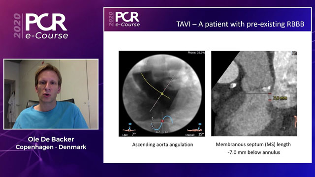 TAVI and the conduction system